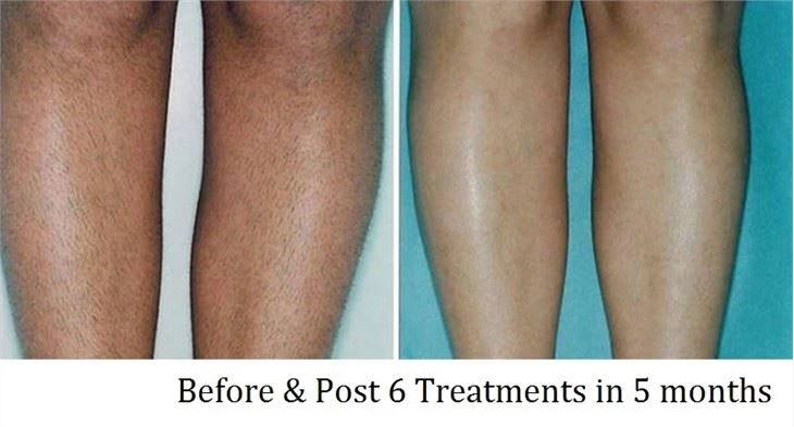 CE Approved Portable IPL SHR Laser Hair Removal Machine